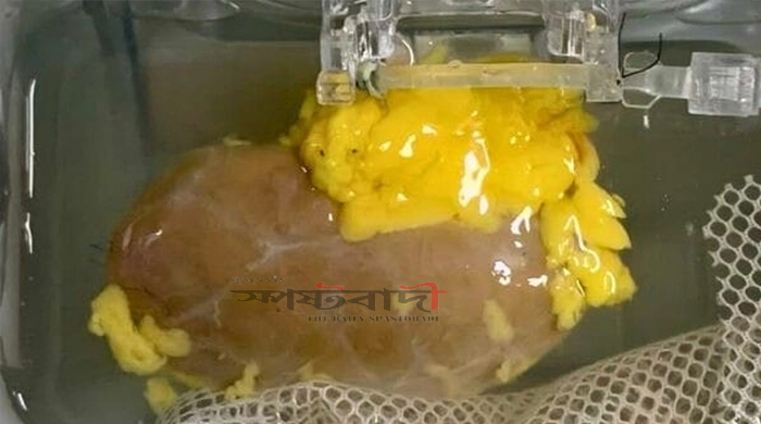 তৈরি হল 'ইউনিভার্সাল' কিডনি ! আর বাধা হবেনা 'ব্লাড-গ্রুপ'